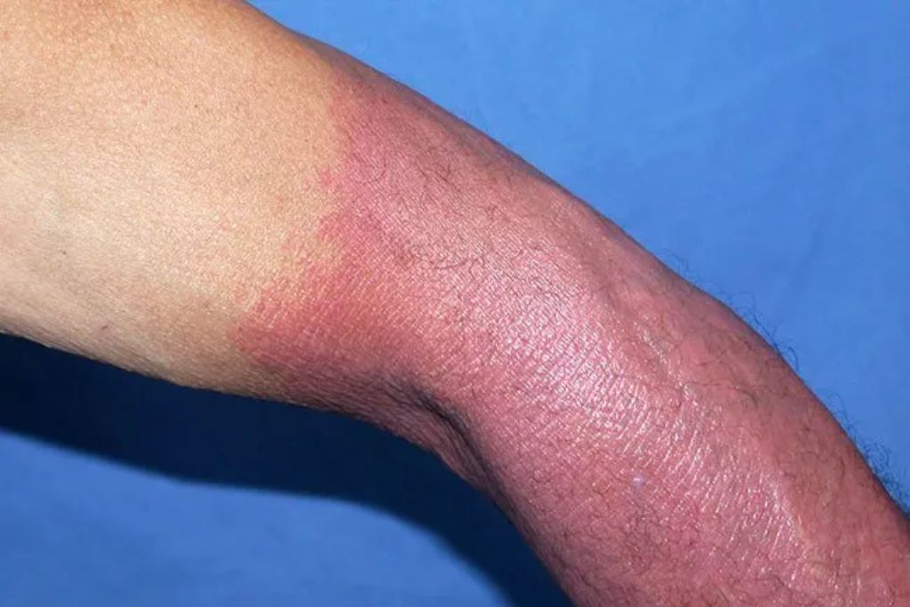 A close-up of a person's arm showing a distinct line of sunburn, with the skin on the lower part of the arm appearing red and irritated compared to the unburned upper section.